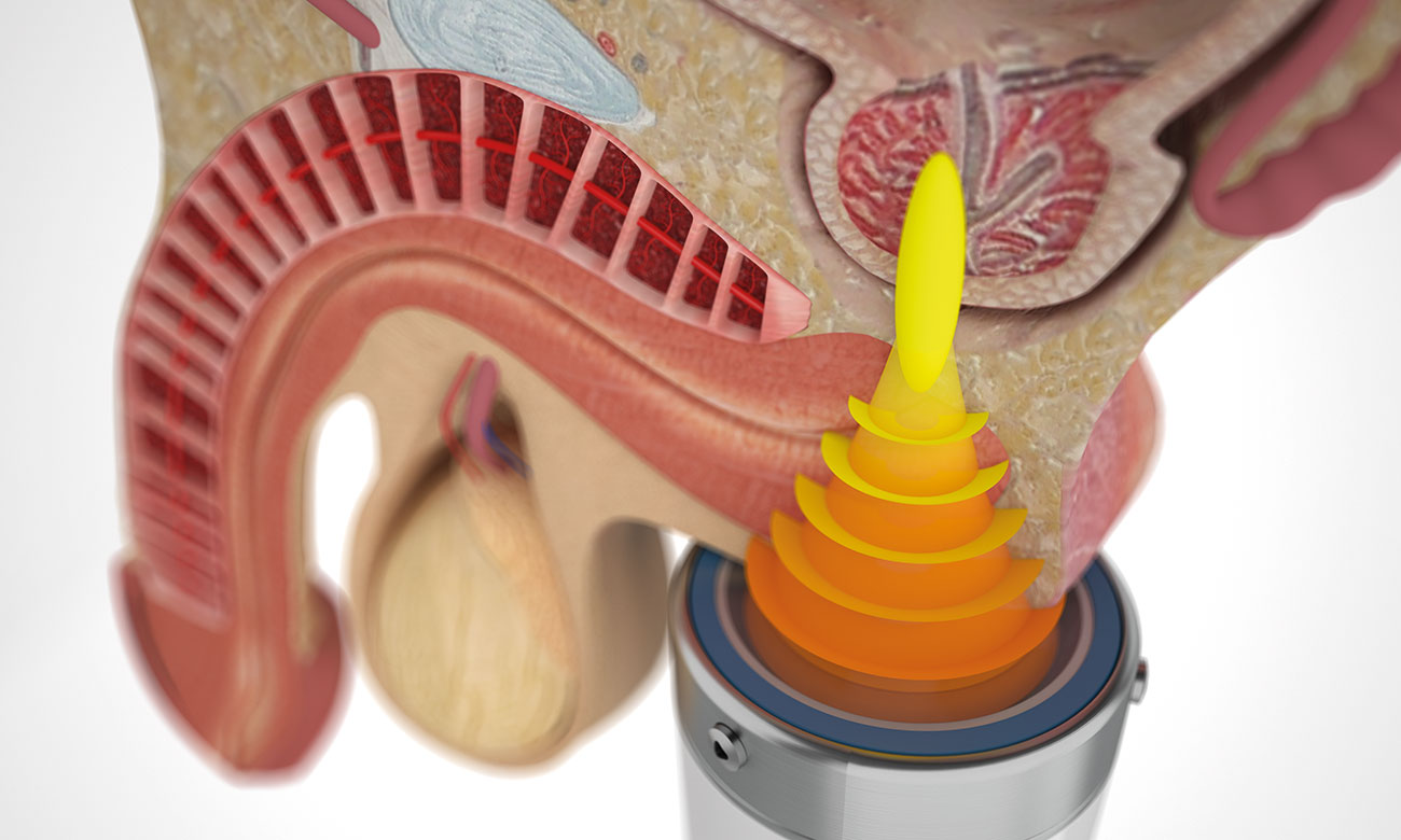 Syndrome de douleur pelvienne chronique (CPPS) chez l’homme