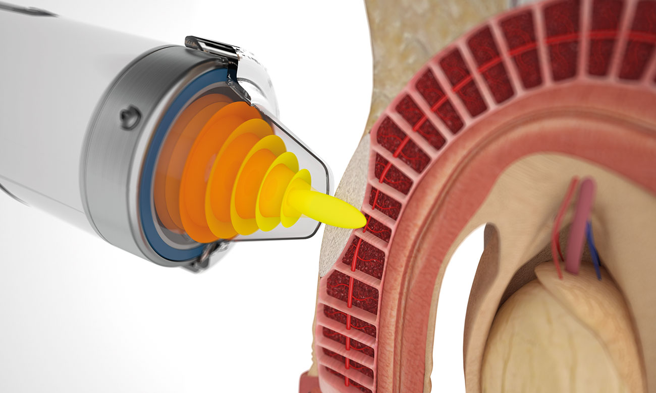 ESWT non invasive pour IPP : réduction efficace de la douleur liée à la maladie de La Peyronie.